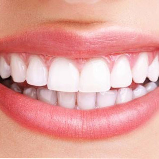 Blanqueamiento Dental LED con Limpieza Bucal en BeYourself (Madrid)
